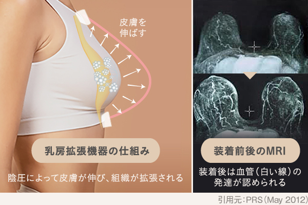 痩せ型の脂肪注入豊胸に効果的な乳房拡張器の仕組みと装着前後のMRI比較