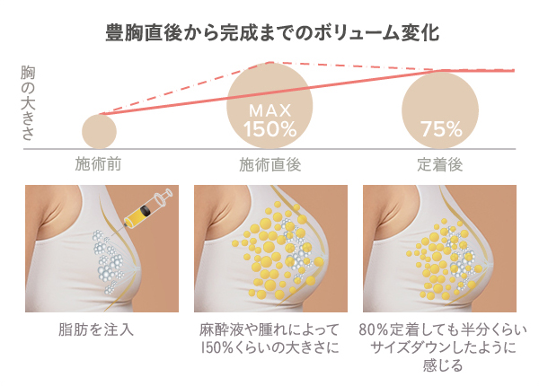 脂肪注入豊胸の直後から完成までのボリューム変化の原因と想定イメージ