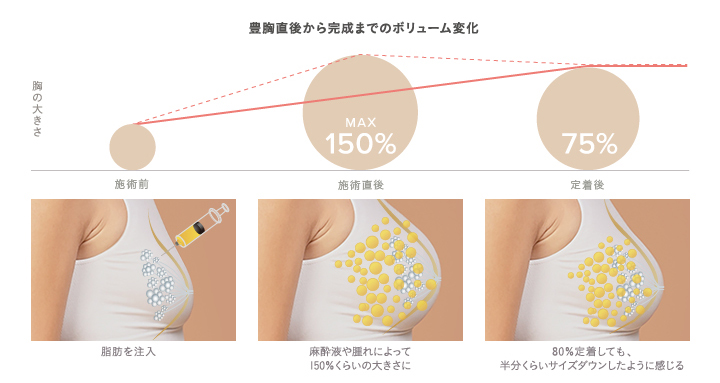 脂肪注入豊胸の直後から完成までのボリューム変化の原因と想定イメージ