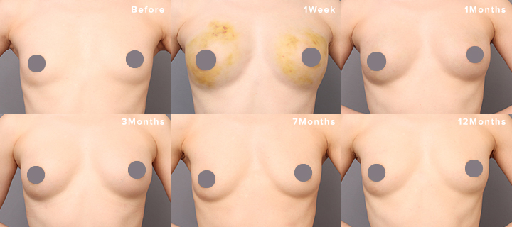 脂肪注入豊胸の手術から1週間後、1か月後、3カ月後、7ヶ月後、1年後までのバストの経過