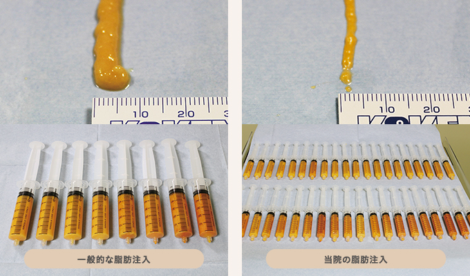 脂肪注入に用いる脂肪