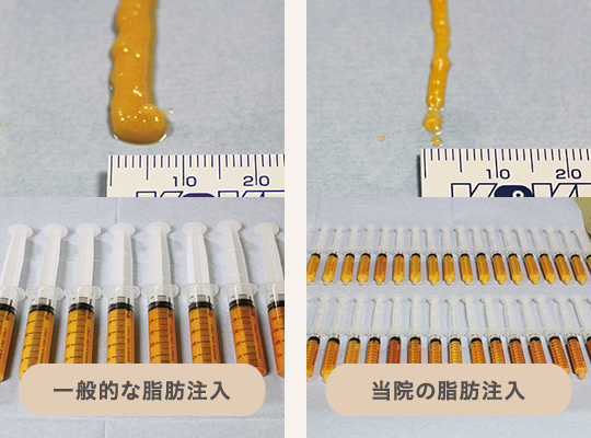 脂肪注入に用いる脂肪