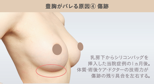 豊胸がバレる原因に傷跡が目立つことがあげられるが、ドクターの技術力や術後ケア次第で目立たなくすることができることが分かるバストクリニックの症例